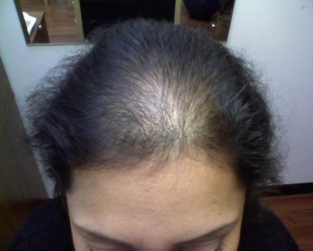 hair photo:iron deficiency hair loss 