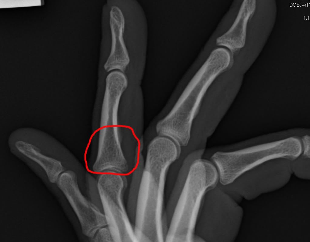 FingerBroken.jpg