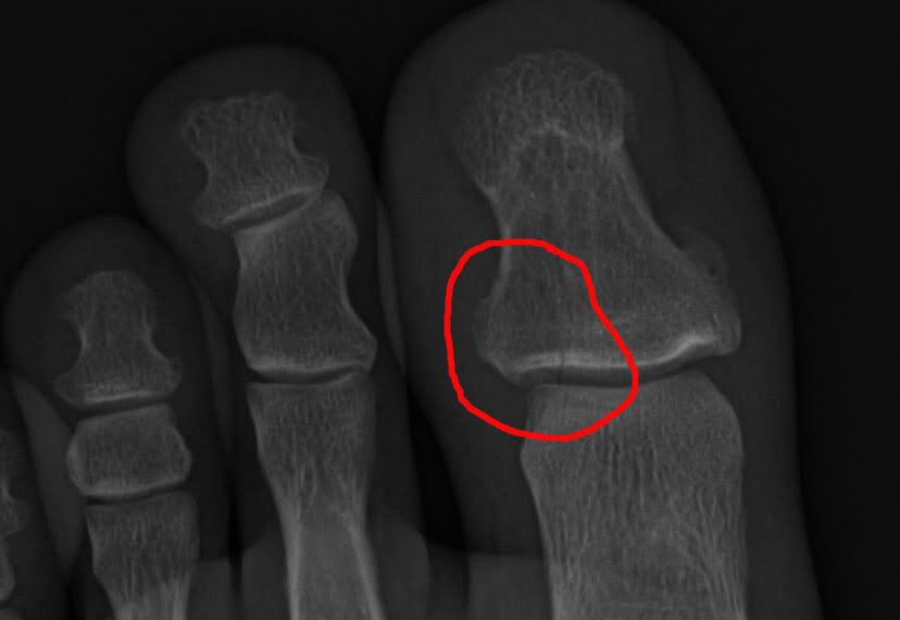 ToeBroken.jpg